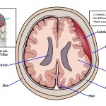 Illustration showing location of brain bleed