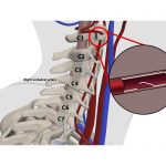 Torn vertebral artery