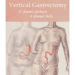 Editorial for Vertical Gastrectomy